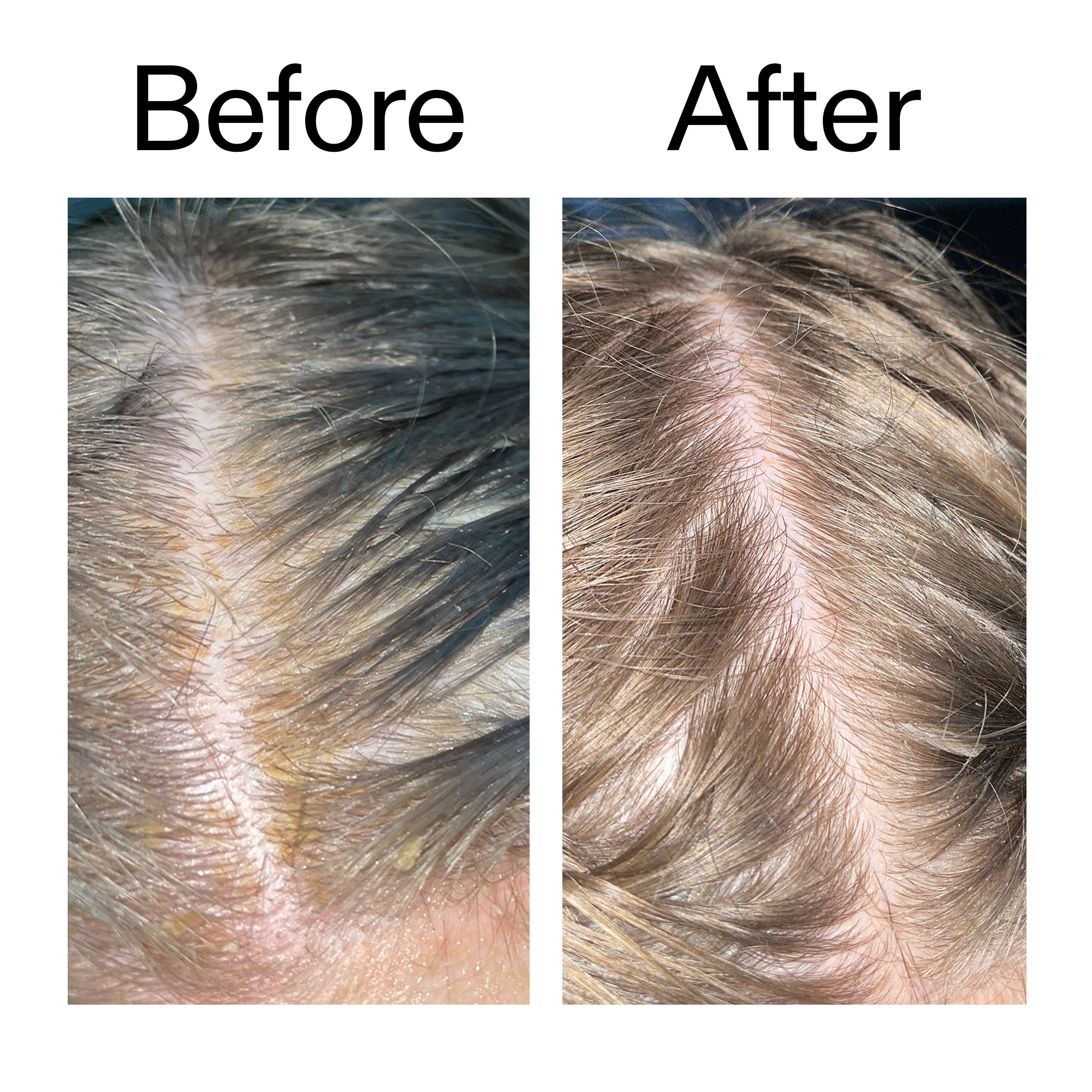 Salicylic Acid Exfoliating Scalp Treatment - Image 9