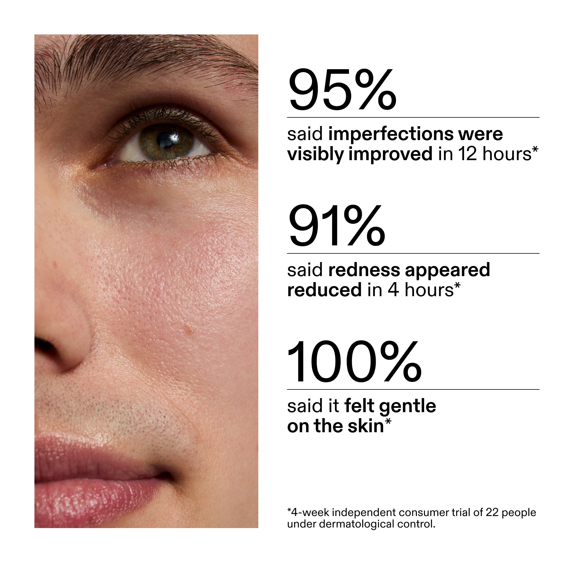 Succinic Acid Acne Treatment - Image 6