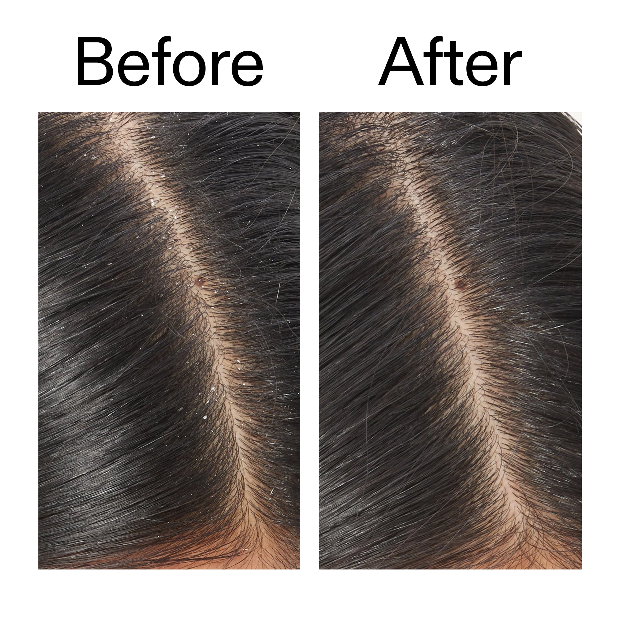 Salicylic Acid Exfoliating Scalp Treatment - Image 10