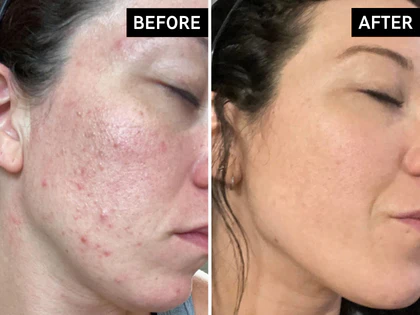 Before and after comparison