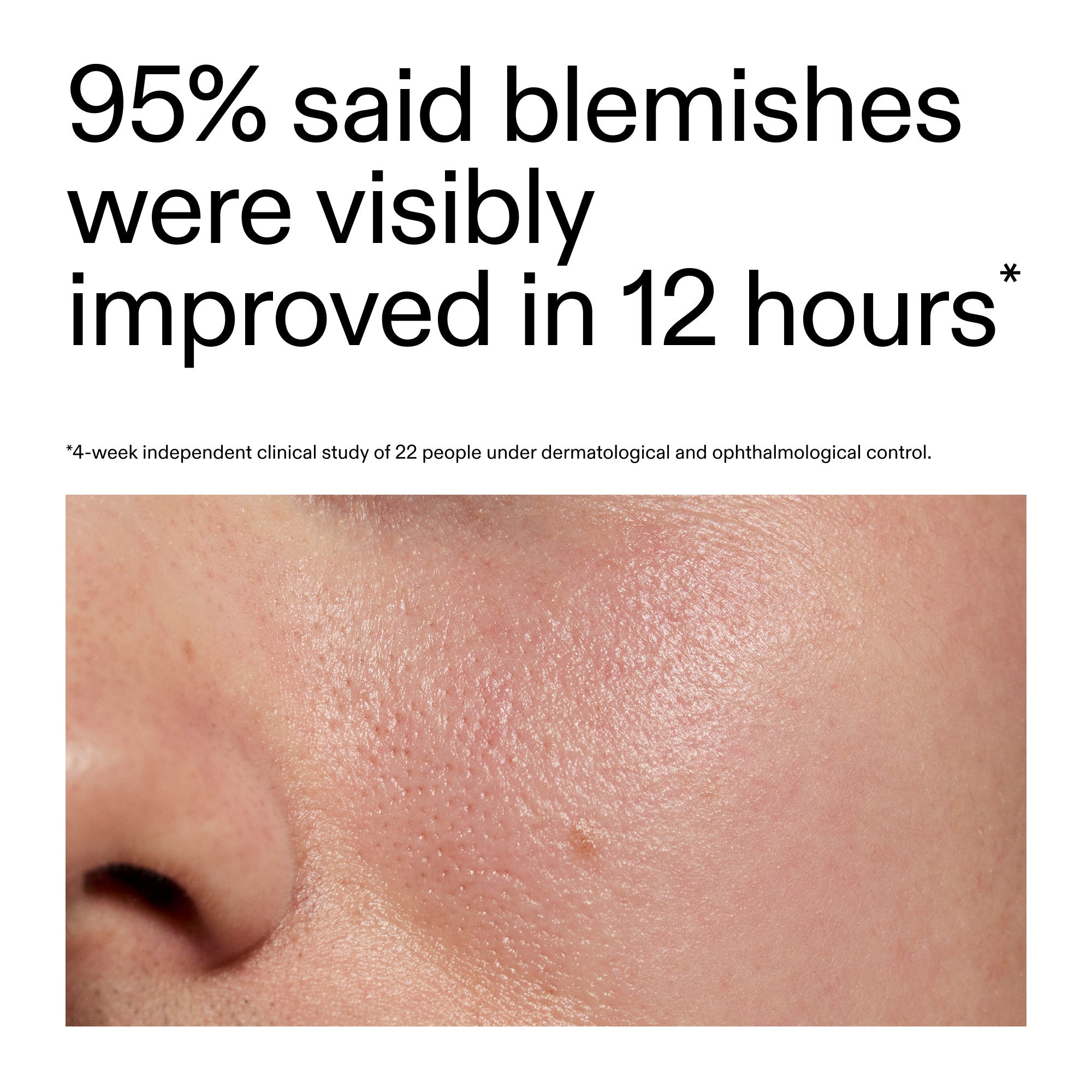 Succinic Acid Acne Treatment - Image 5