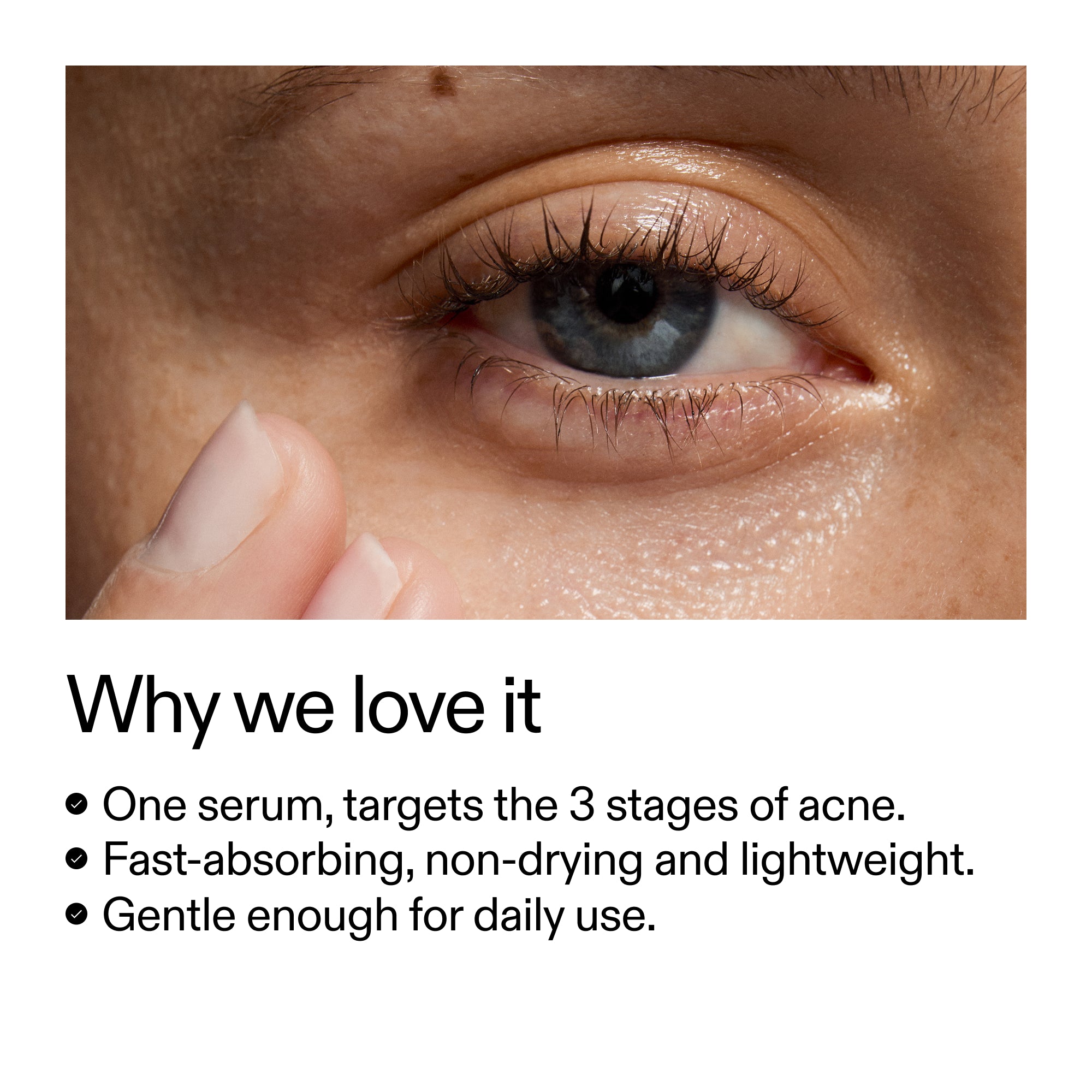360° Acne Clearing Duo - Image 4