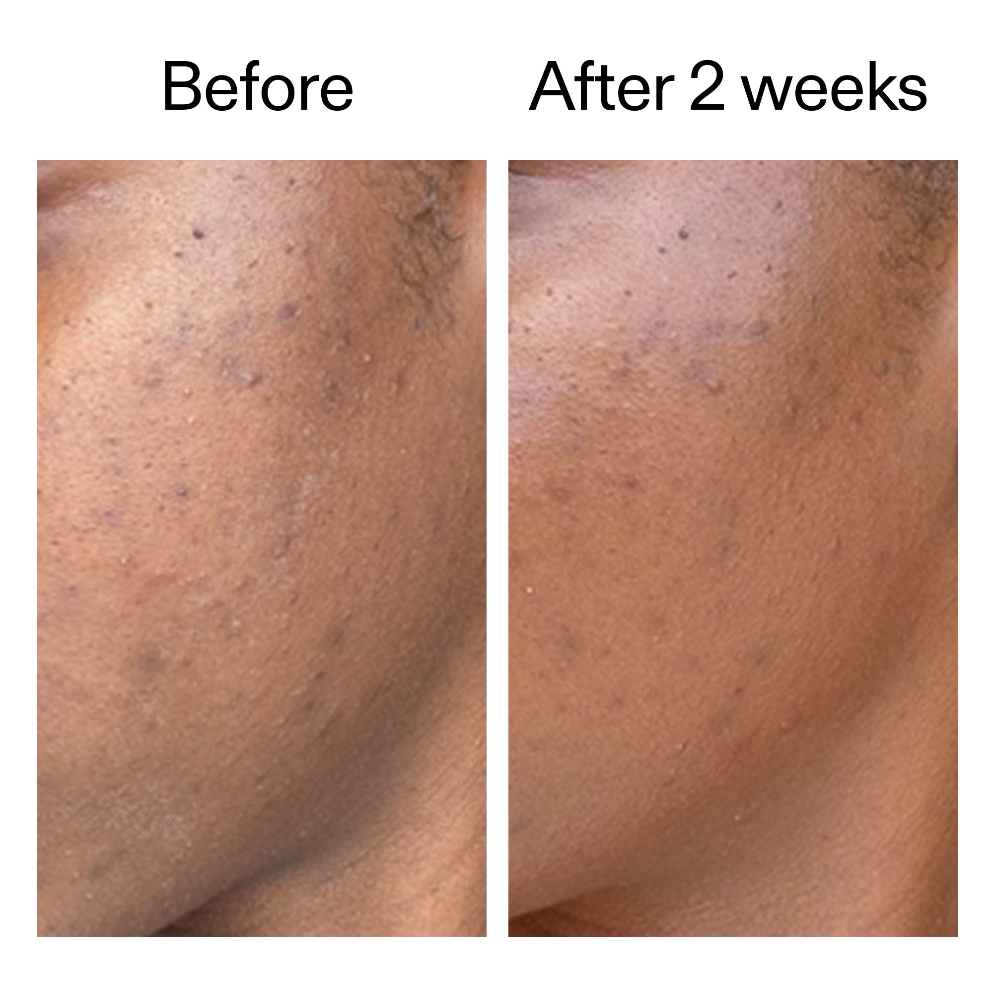 360° Acne Clearing Duo - Image 5