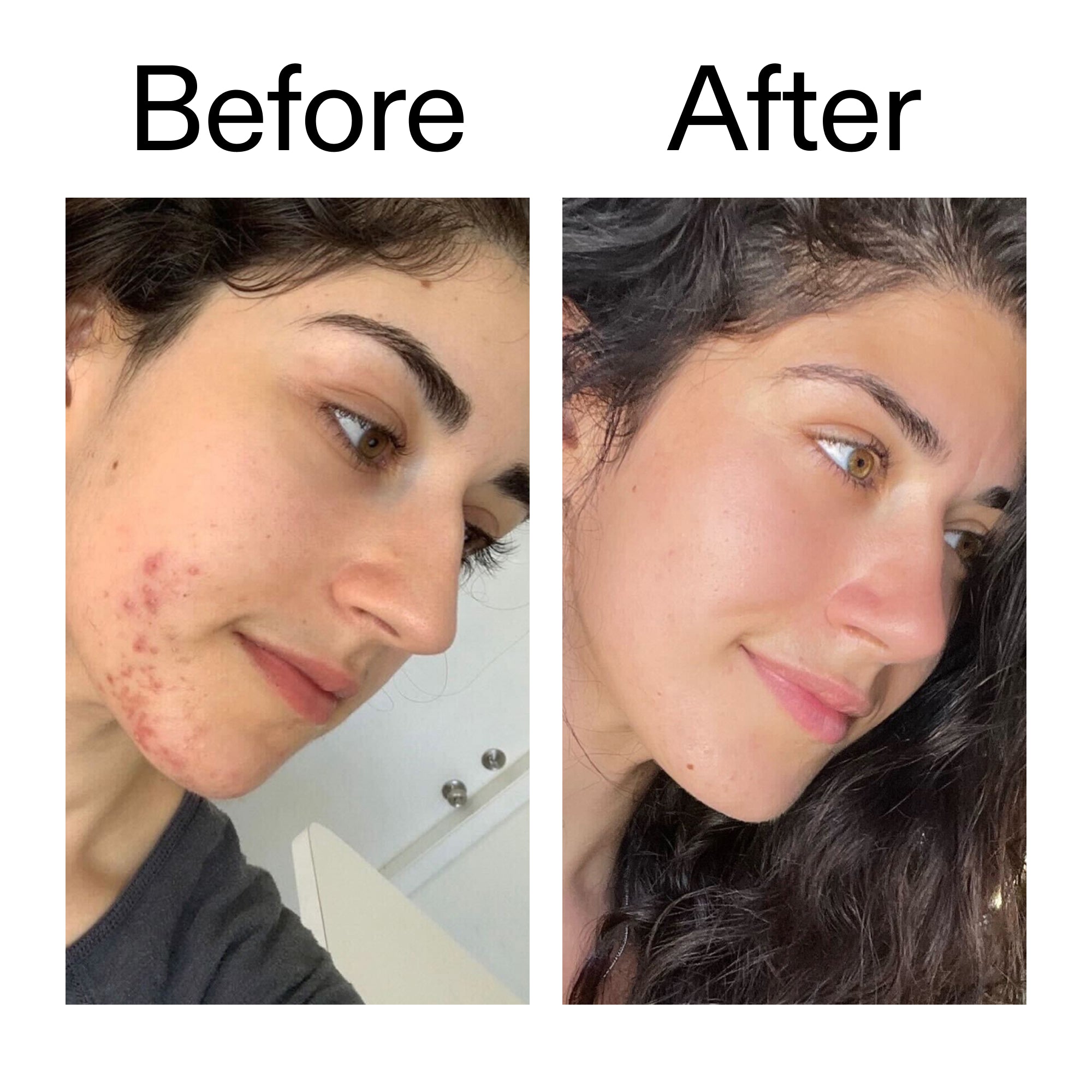 Succinic Acid Acne Treatment - Image 11