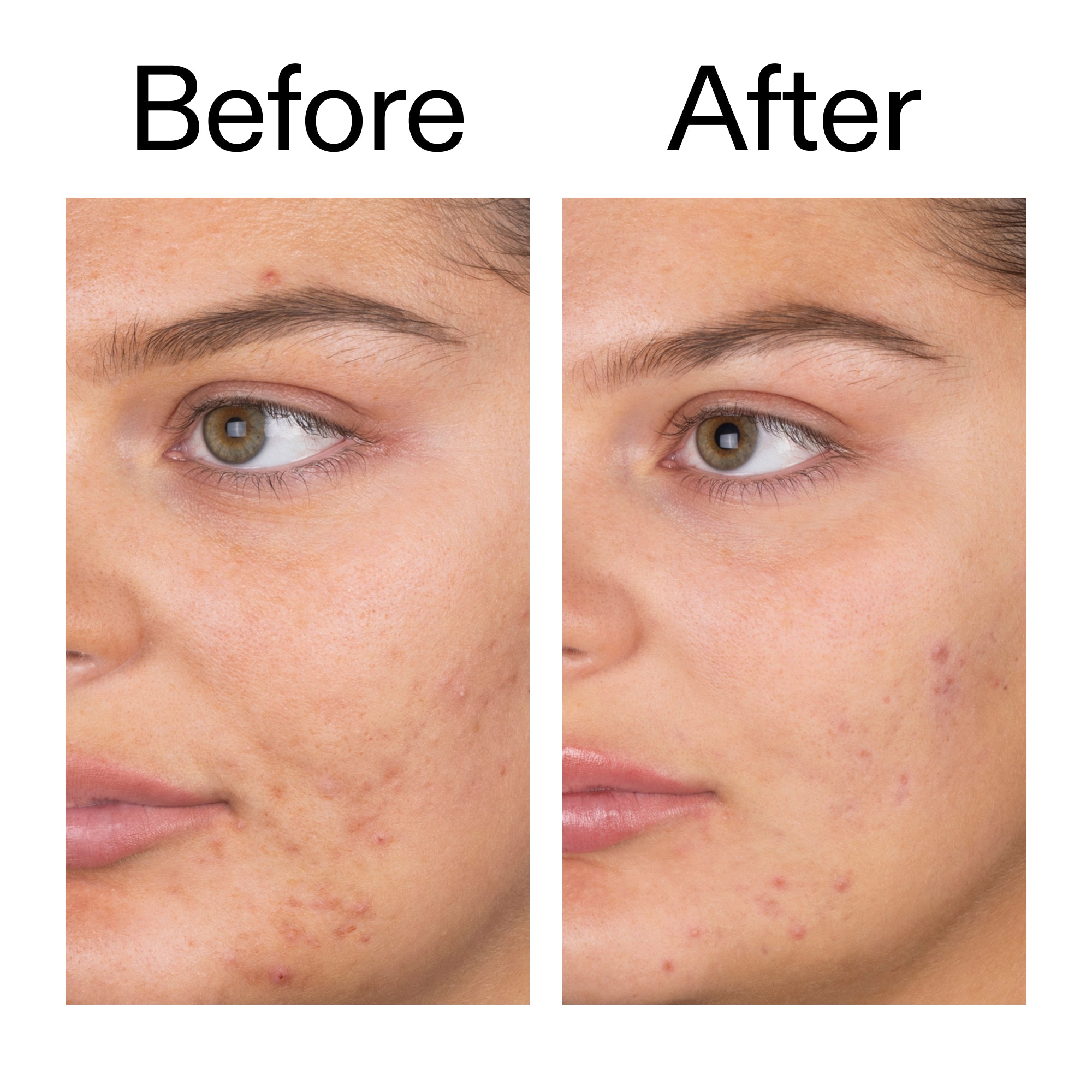 Salicylic Acid Cleanser - 150ml - Image 10
